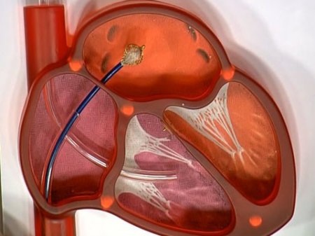 Ученые разработали препарат от ишемической болезни сердца и инсульта