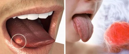 Предупреждение о раке языка: Названы семь неочевидных симптомов у курильщиков